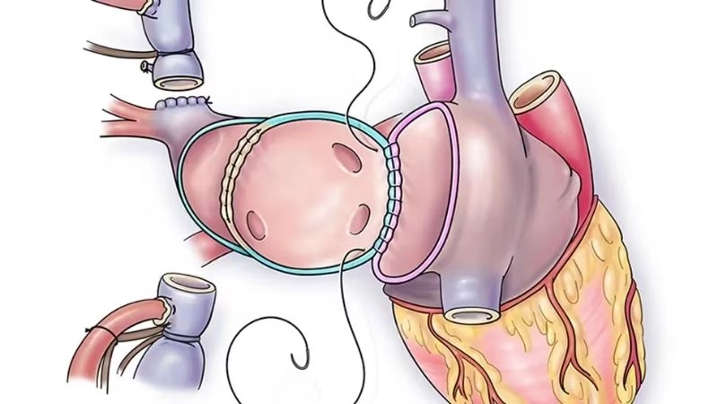 Partial anomalous pulmonary venous return in adults prognosis