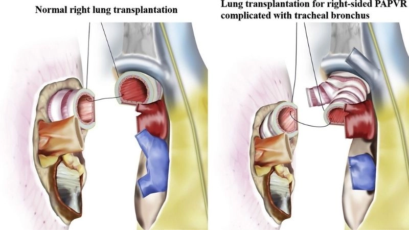 Partial anomalous pulmonary venous return chest x ray findings