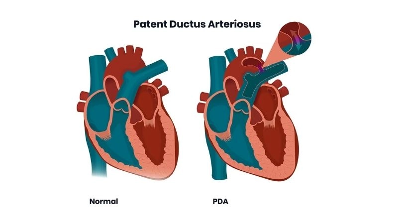 Patent ductus arteriosus symptoms early signs of heart condition