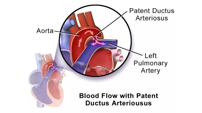 PDA treatment medical options to manage the defect