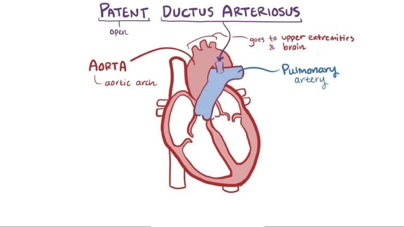 Patent ductus arteriosus in adults rare but possible diagnosis
