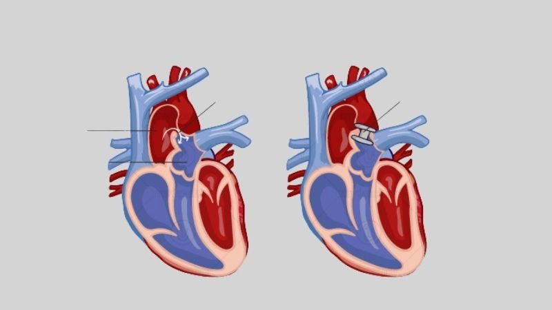 Patent ductus arteriosus murmur common sound in the heart