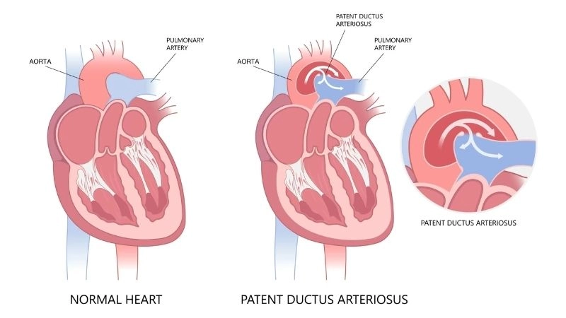 Patent ductus arteriosus causes congenital heart development issue