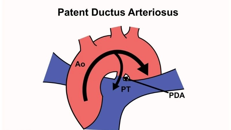 Patent ductus arteriosus surgery repairing the heart connection