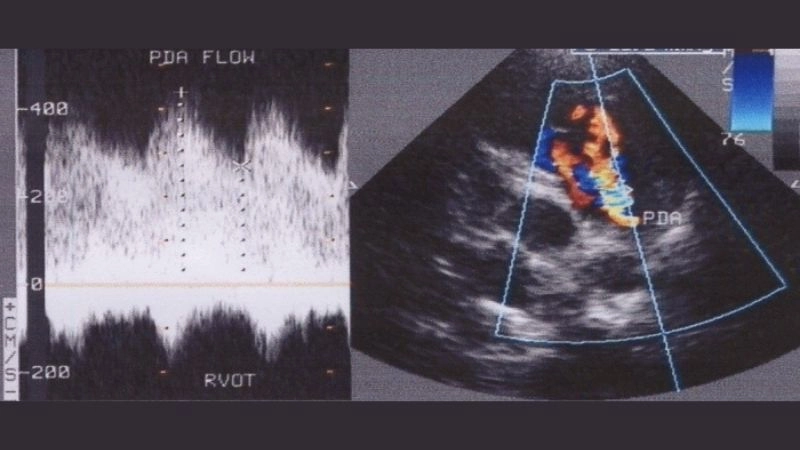 Patent ductus arteriosus in infants frequent congenital condition
