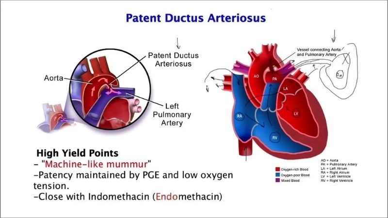 Patent ductus arteriosus diagnosis early detection saves lives