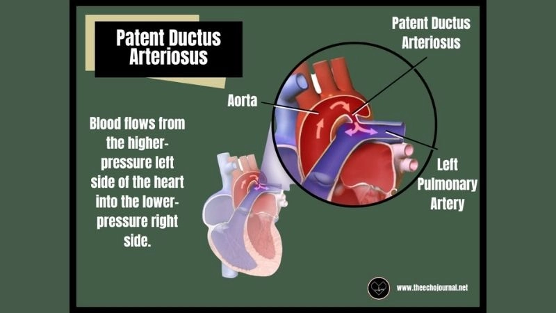PDA closure sealing abnormal heart vessel opening