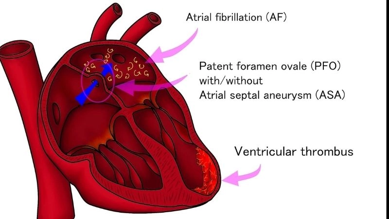 Patent foramen ovale stroke hidden heart defect linked to stroke