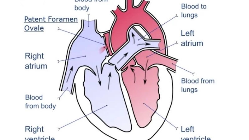 Patent foramen ovale symptoms subtle signs often overlooked