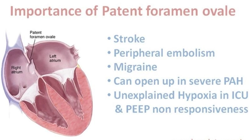 Cryptogenic stroke and PFO unexplained strokes tied to defect