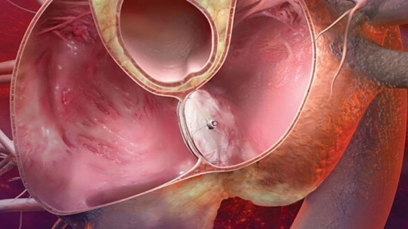 Patent foramen ovale surgery repairing congenital heart hole