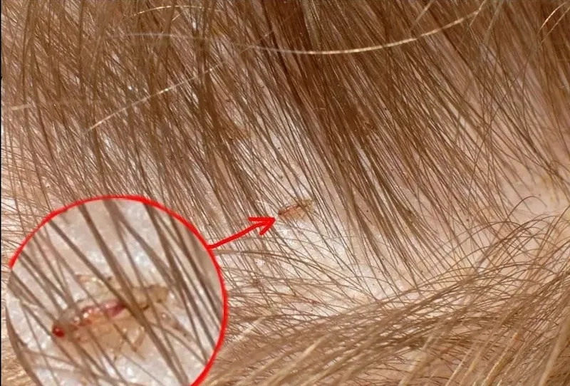 Microscopic view of pubic lice (crabs) for identification