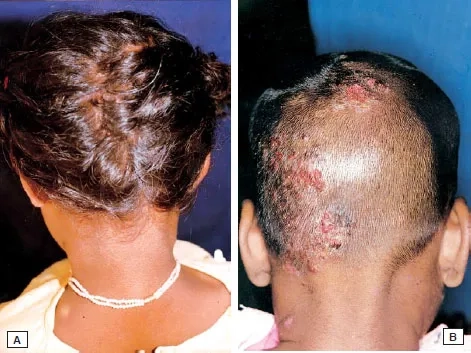 A medical examination for the presence of body lice