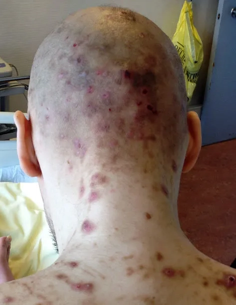 A guide on how to get rid of head lice effectively