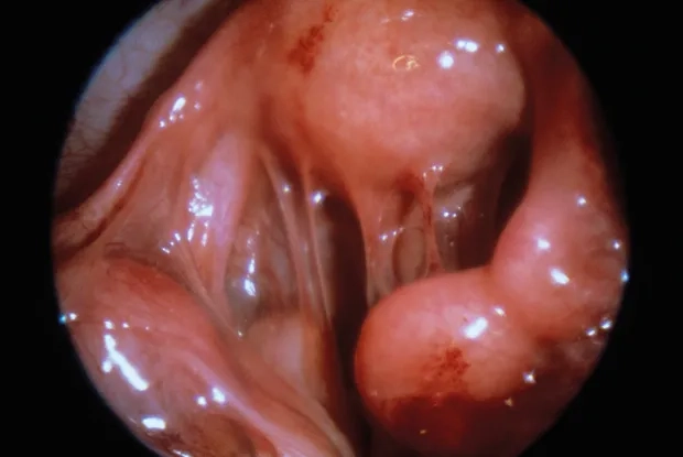 Understanding the long-term effects of PID on health