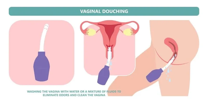 Recognizing Pelvic Inflammatory Disease (PID) symptoms early