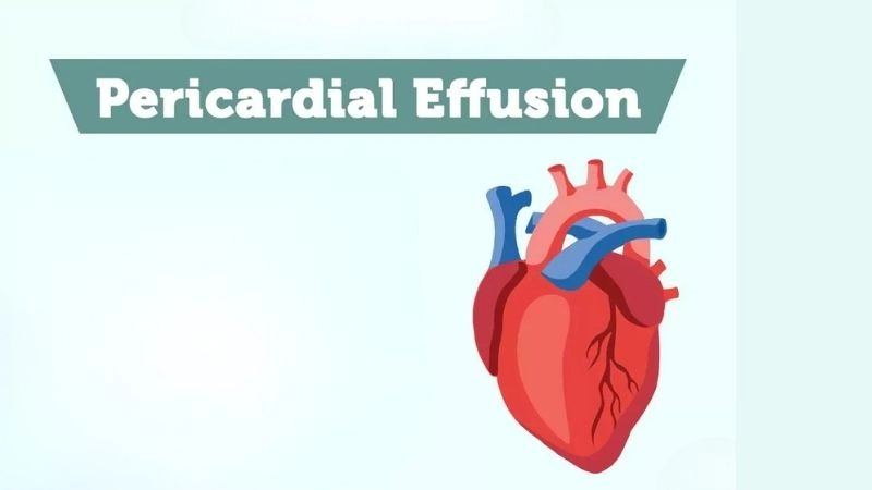 Pericardial effusion symptoms warning signs of fluid buildup