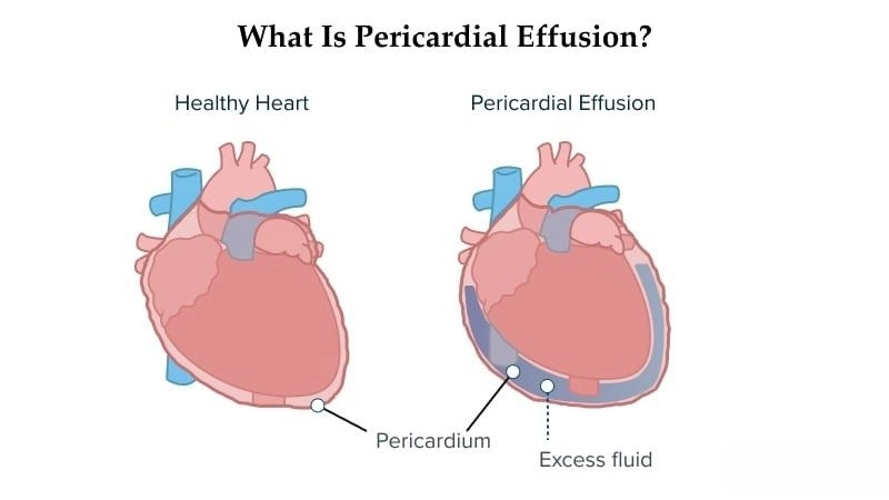 Pericardial effusion causes underlying triggers of condition