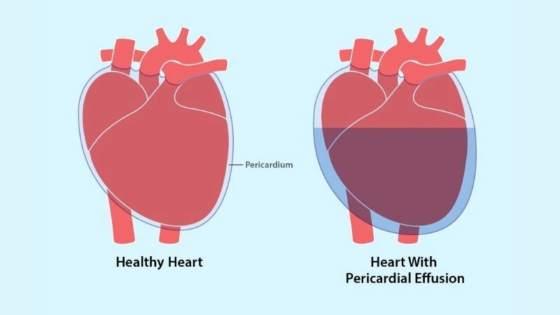 Pericardial effusion vs cardiac tamponade key clinical differences