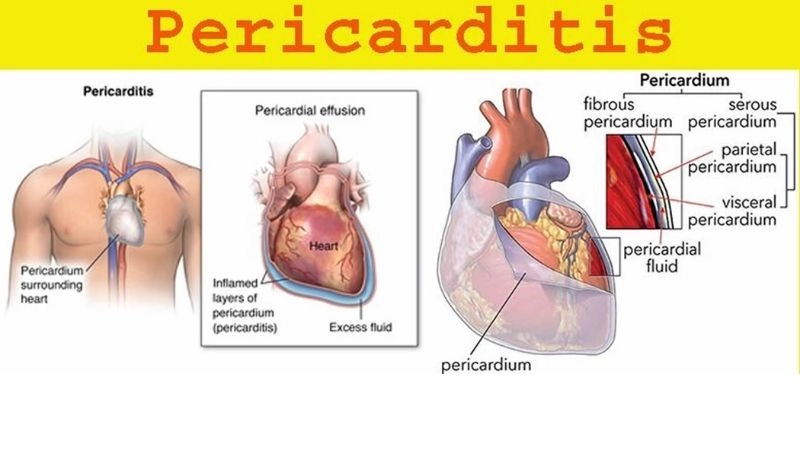 Pericardial effusion chest pain discomfort caused by fluid pressure