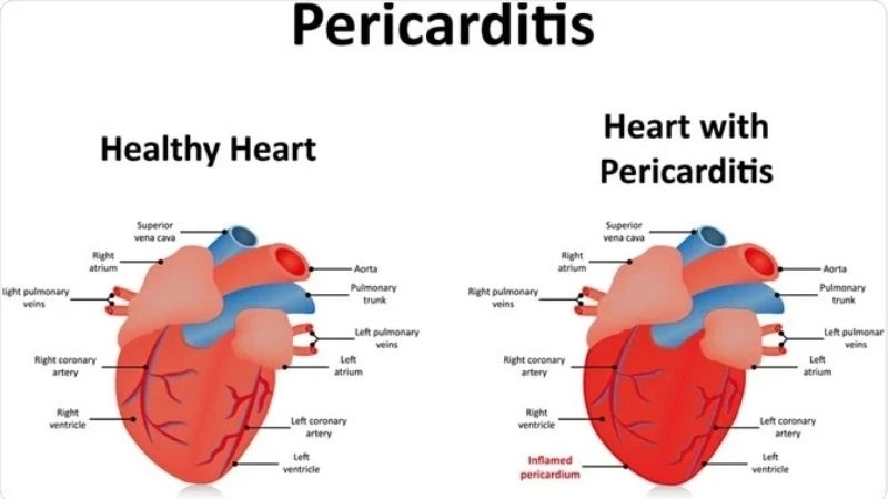 Pericarditis treatment medical care for heart lining disease