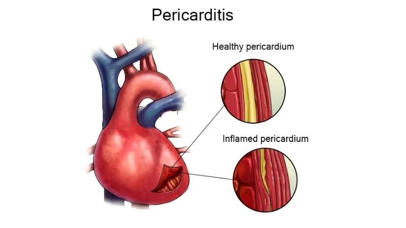 Pericarditis causes underlying triggers of heart inflammation
