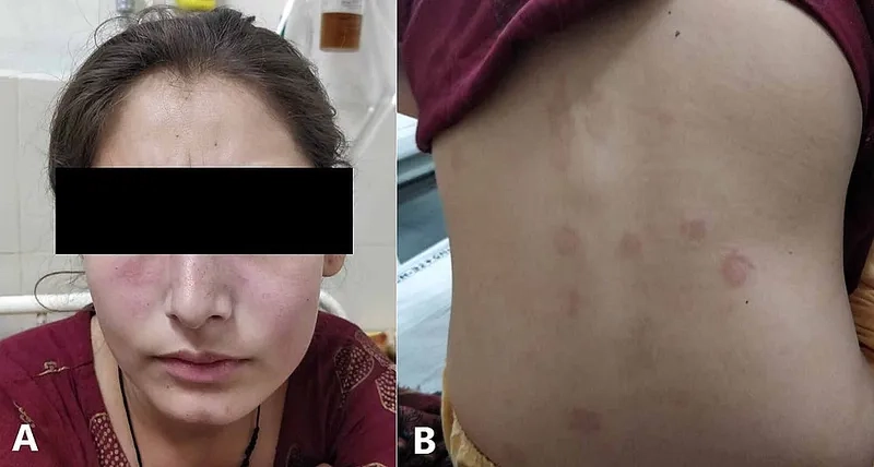 The signs and stages of acute pericarditis