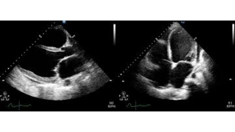 Peripartum cardiomyopathy breastfeeding safe with guidance