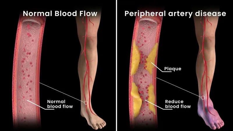 A diagram explaining what is peripheral artery disease