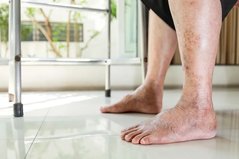 Visual signs of poor circulation in legs caused by PAD