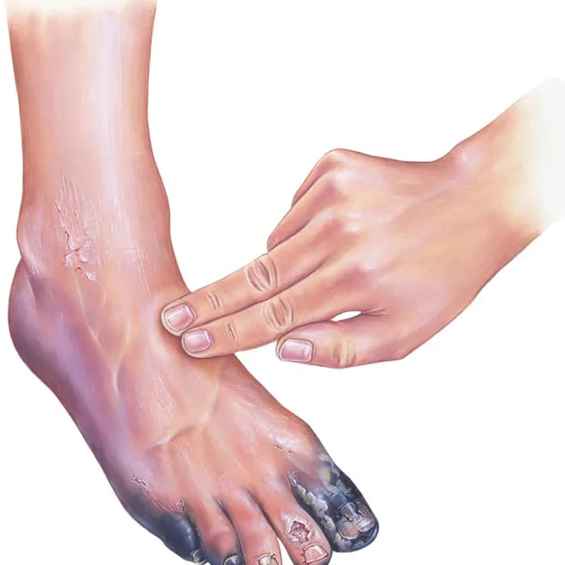 An overview of modern PAD treatment options for patients