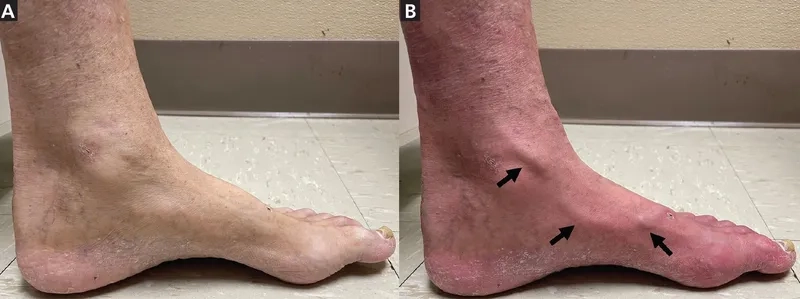 Lifestyle changes for peripheral artery disease prevention