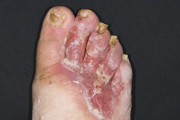 A person experiencing leg pain when walking due to PAD