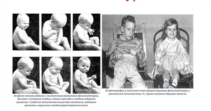 Visual guide to phenylketonuria symptoms