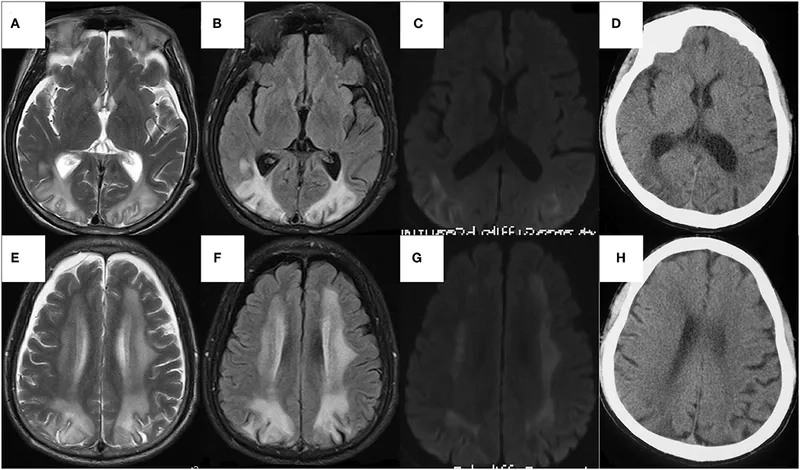 Specialized PKU formula for infants