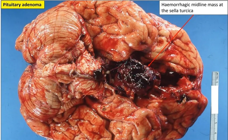 Before and after photos of pituitary surgery patients