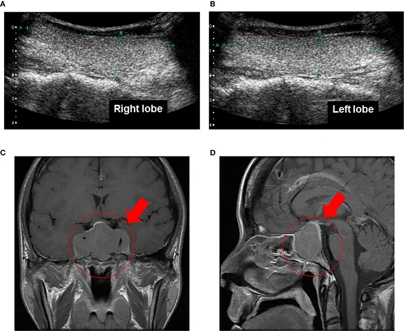 Step-by-step graphic of transsphenoidal surgery
