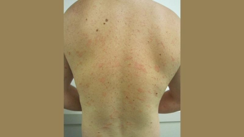 Effective pityriasis rosea treatment guide