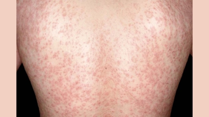 Identifying pityriasis rosea rash clearly