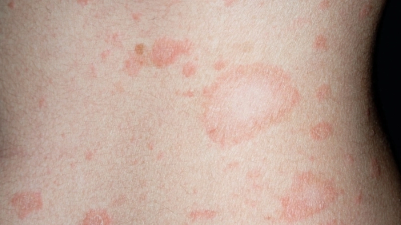 Is pityriasis rosea contagious or not