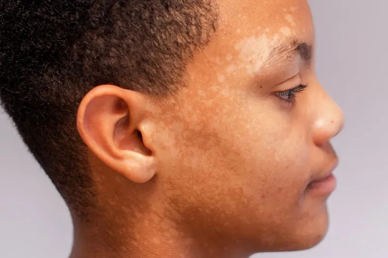 An overview of effective tinea versicolor treatment options