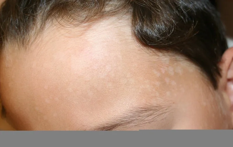 A visual guide on how to get rid of pityriasis versicolor