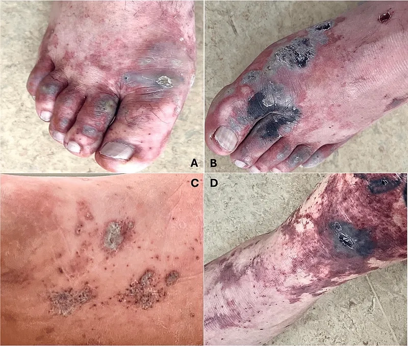 Administering emergency septicemic plague treatment