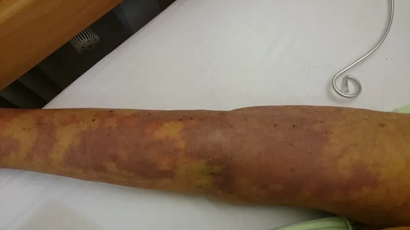 An infographic explaining what is septicemic plague