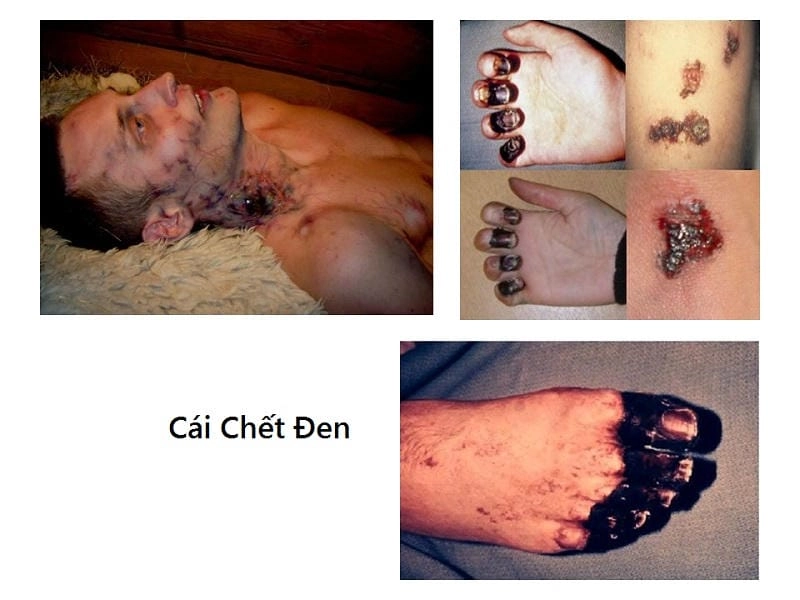 Chart comparing pneumonic plague vs bubonic plague