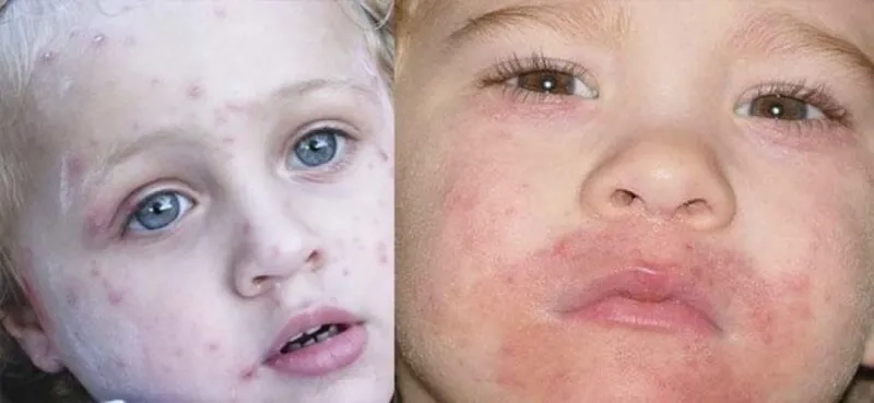 A vial of the pneumococcal disease vaccine