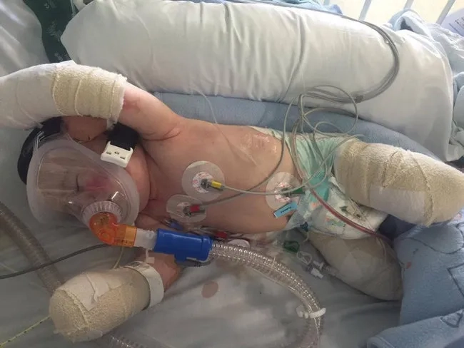 A clear visual of the pneumonia disease definition