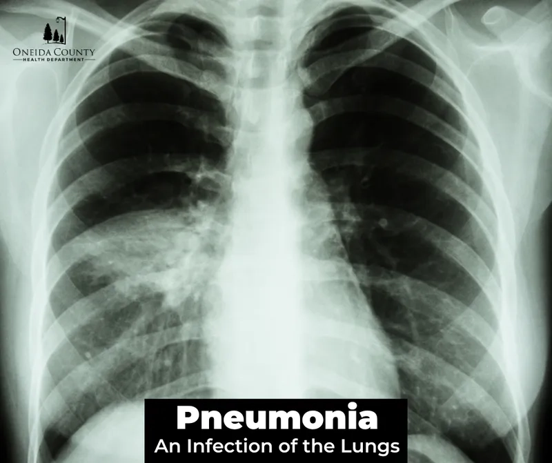 The serious risks of invasive pneumococcal disease