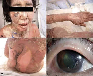 The impact of PCP in HIV/AIDS patients