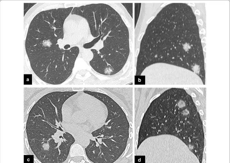 Person experiencing common pneumonia symptoms